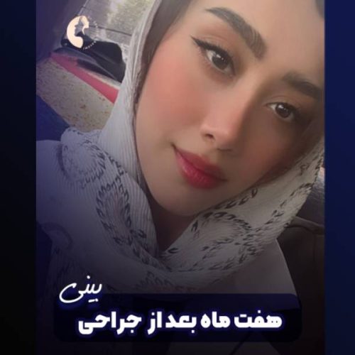 جراحی-بینی-614