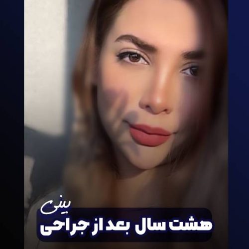 جراحی-بینی-618