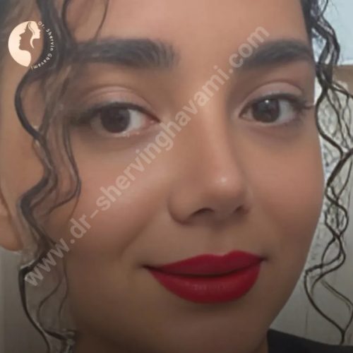 جراحی-بینی-621