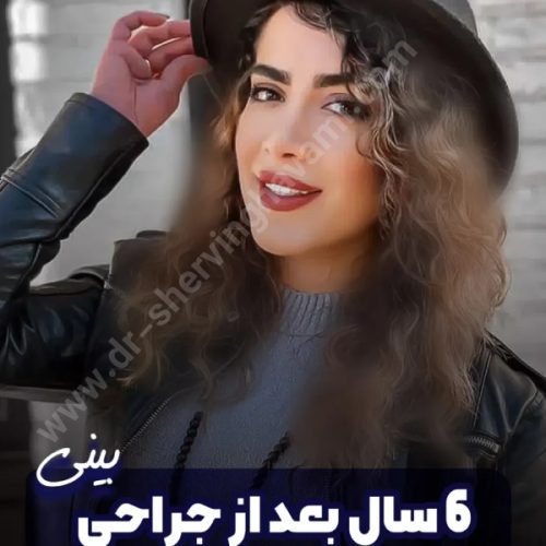 جراحی-بینی-622
