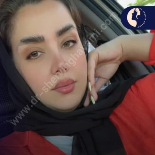 جراحی-بینی-625