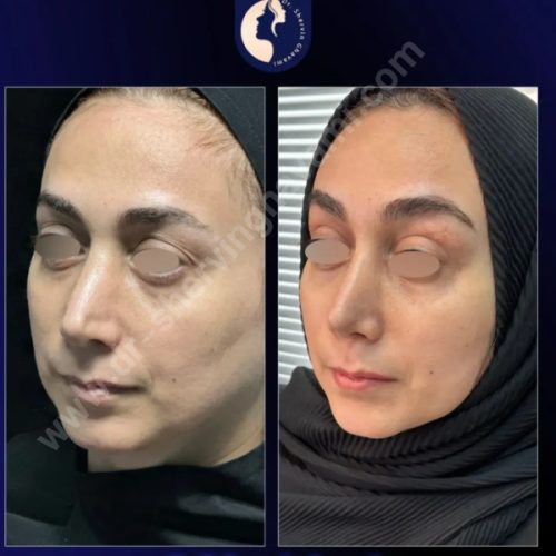 جراحی-بینی-628