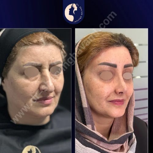 جراحی-بینی-629