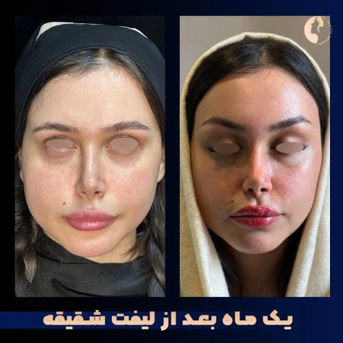 لیفت-شقیقه-24