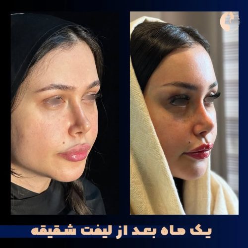 لیفت-شقیقه-25