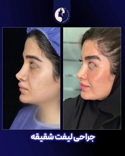 لیفت-شقیقه-27