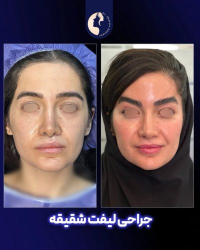 لیفت-شقیقه-28
