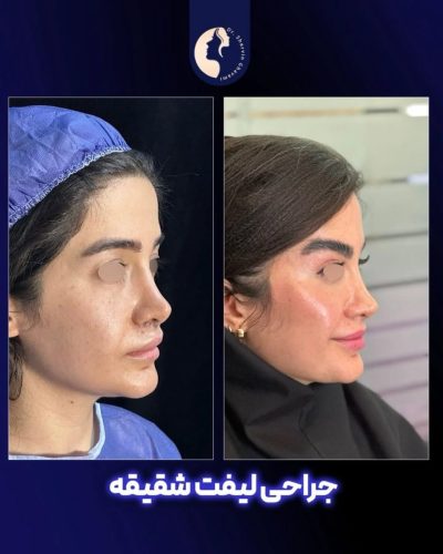 لیفت-شقیقه-29