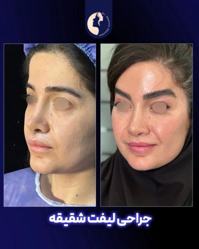لیفت-شقیقه-30