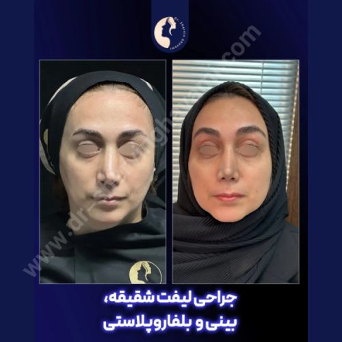 لیفت-شقیقه-31