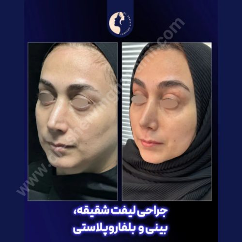 لیفت-شقیقه-32