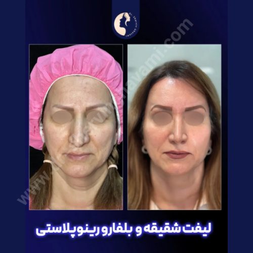 لیفت-شقیقه-33