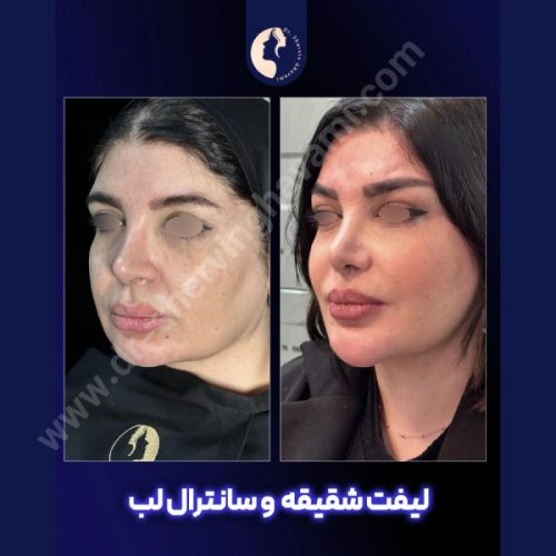 لیفت-شقیقه-34