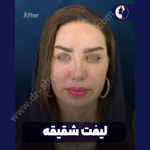لیفت-شقیقه-35