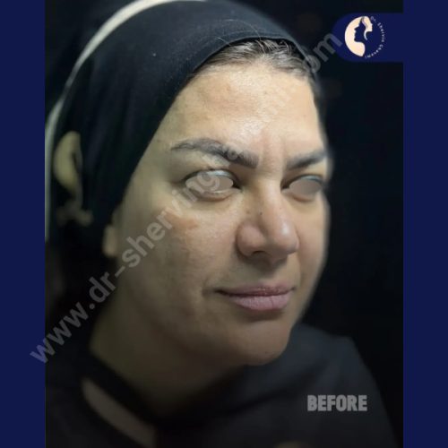 لیفت-شقیقه-38